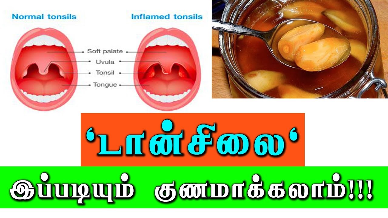 டான்சில்லிடிஸ் என்றால் என்ன